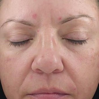 35-44 year old woman treated with Glycolic Peel before 2005153