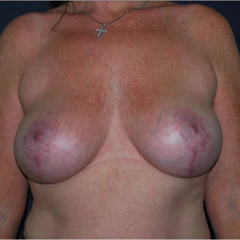35-44 year old woman with asymmetrical and large breasts treated with breasts reduction. after 2987279
