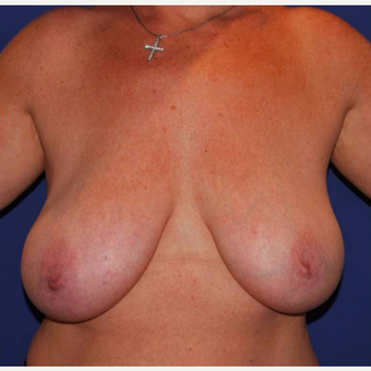 35-44 year old woman with asymmetrical and large breasts treated with breasts reduction. before 2987279