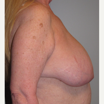 55-64 year old woman treated with Breast Reduction before 3175208