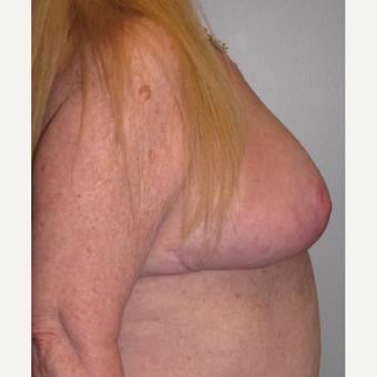 55-64 year old woman treated with Breast Reduction after 3175208