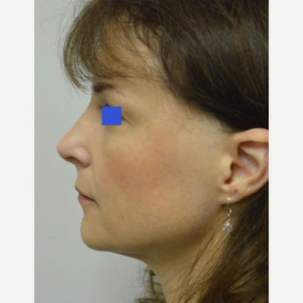 45-54 year old woman treated with a wide nose treated with a Rhinoplasty before 3482848