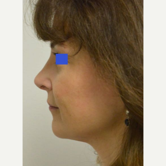 45-54 year old woman treated with a wide nose treated with a Rhinoplasty after 3482848