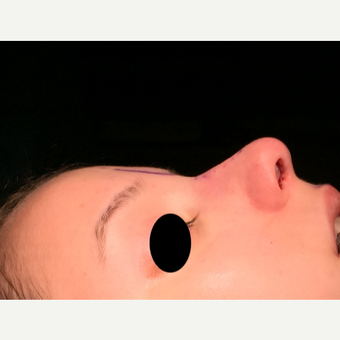 18-24 year old woman treated with Rhinoplasty after 3211312