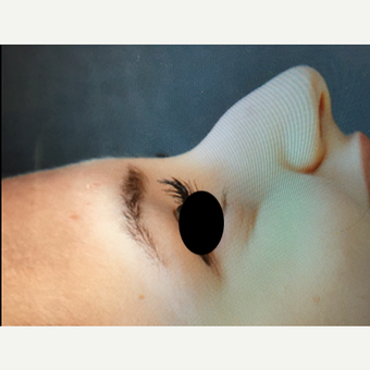18-24 year old woman treated with Rhinoplasty before 3211312