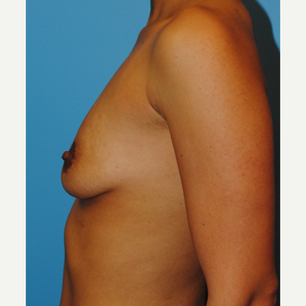27 year old woman treated with Breast Implants, Saline B to full C cup before 3624404