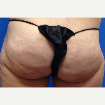 45-54 year old woman treated with Cellfina after 3708719