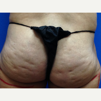 45-54 year old woman treated with Cellfina before 3708719