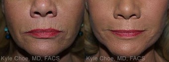 Dermabrasion for lines around the mouth before 1465999