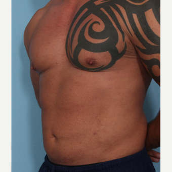 35-44 year old man treated with Fat Transfer after 3589533