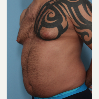 35-44 year old man treated with Fat Transfer before 3589533