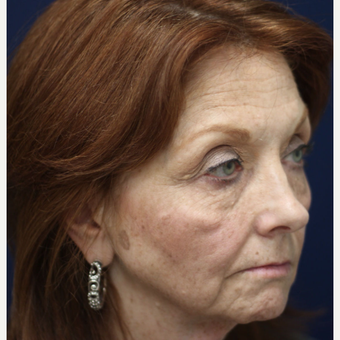55-64 year old woman treated with Injectable Fillers before 3243112
