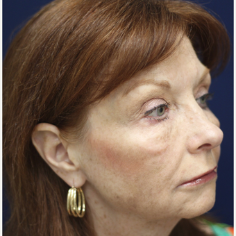 55-64 year old woman treated with Injectable Fillers after 3243112