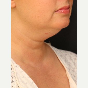 Chin Liposuction before 3617114