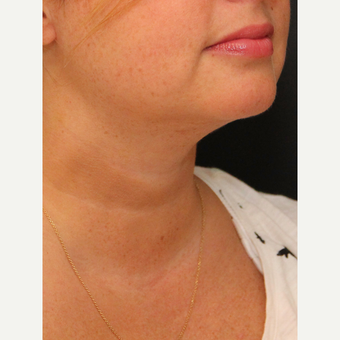 Chin Liposuction after 3617114