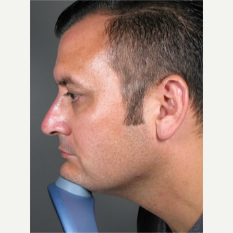 Voluma Non Surgical Nose Job™ after 3042488