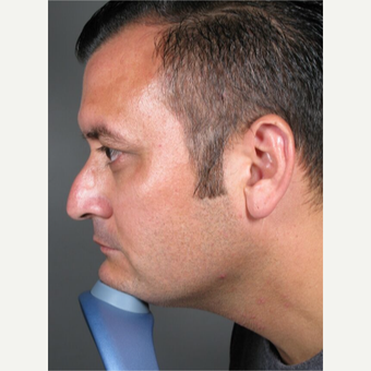 Voluma Non Surgical Nose Job™ before 3042488
