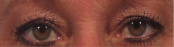 Upper eyelid lift (blepharoplasty) with CO2 laser skin resurfacing before 3291850