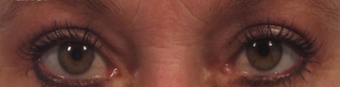 Upper eyelid lift (blepharoplasty) with CO2 laser skin resurfacing after 3291850