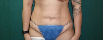 25-34 year old woman treated with Tummy Tuck before 3659689