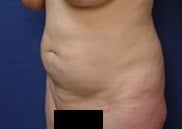 45-54 year old woman treated with Mini Tummy Tuck before 2073544