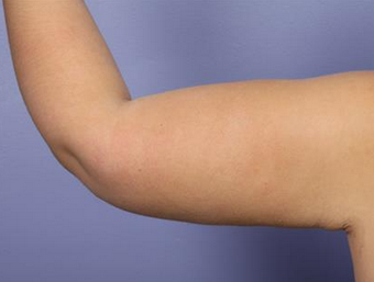 25-34 year old woman treated with Arm Lift after 1679036