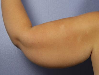 25-34 year old woman treated with Arm Lift before 1679036