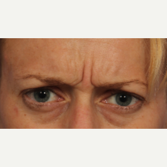 35-44 year old woman treated with Botox before 3787922