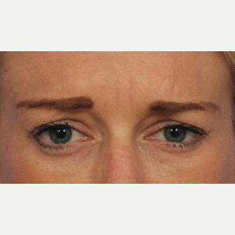 35-44 year old woman treated with Botox after 3787922