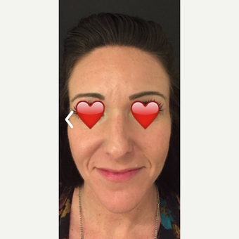 35-44 year old woman treated with Botox before 3764120
