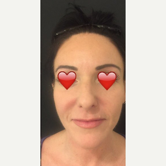 35-44 year old woman treated with Botox after 3764120
