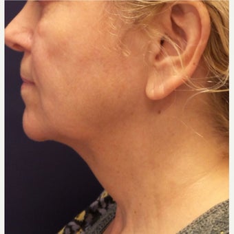 55-64 year old woman treated with Kybella after 2389234