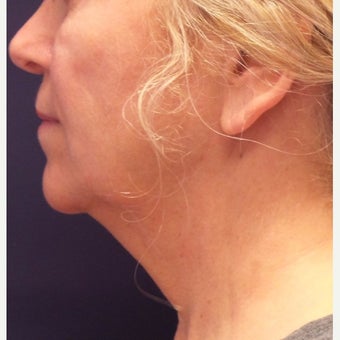 55-64 year old woman treated with Kybella before 2389234