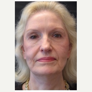 65-74 year old woman treated with Facelift before 3088549