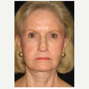 65-74 year old woman treated with Facelift after 3088549