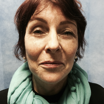 55-64 year old woman treated with Facelift after 3265132