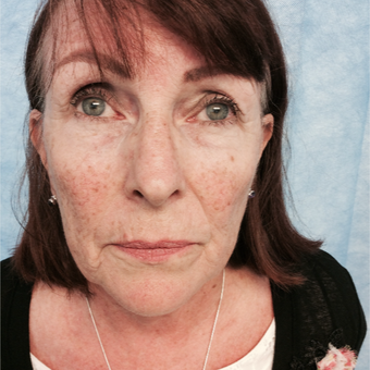 55-64 year old woman treated with Facelift before 3265132