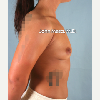 18-24 year old woman treated with Sientra Breast Implants before 3266860