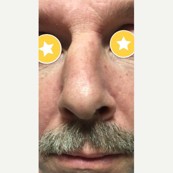 45-54 year old man treated with Rhinoplasty before 3782472