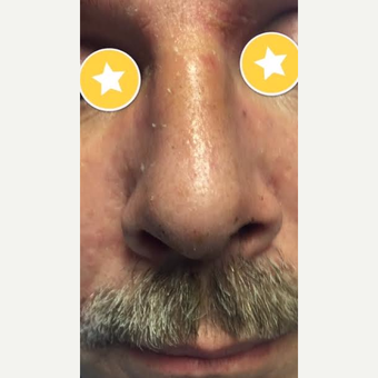 45-54 year old man treated with Rhinoplasty after 3782472