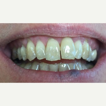 45-54 year old woman treated with Porcelain Veneers before 1966478