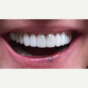 45-54 year old woman treated with Porcelain Veneers after 1966478