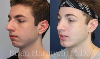 19 year-old male before and 9 months after Rhinoplasty and Chin Implant before 3447244