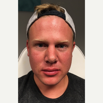 25-34 year old man treated with Juvederm Volbella after 3781906