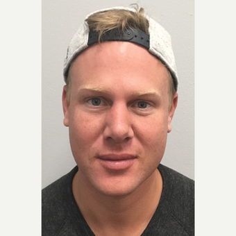 25-34 year old man treated with Juvederm Volbella before 3781906