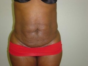 28 year old - tummy tuck and liposuction before 1069990