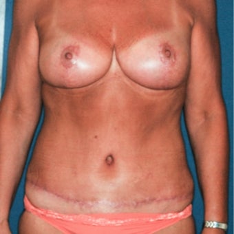 45-54 year old woman treated with Mommy Makeover after 2297097