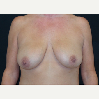 45-54 year old woman treated with Breast Lift with Implants before 3305957