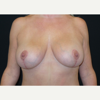 45-54 year old woman treated with Breast Lift with Implants after 3305957