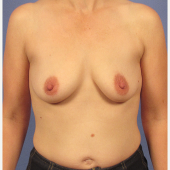 35-44 year old woman treated with Breast Augmentation before 3106746